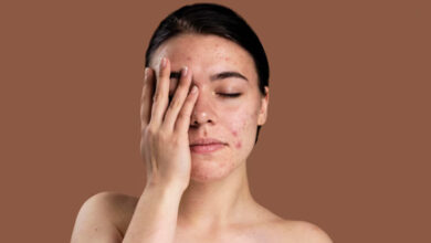 Dairy Causes Acne