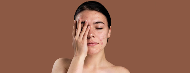 Dairy Causes Acne